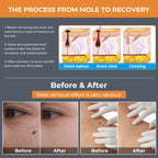 15 Gears Mole Removal Pen - Laser Freckle Spot Eraser for Home - 15 gears laser pen - Image 5