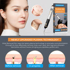 Using 15 Gears Mole Removal Pen - Laser Freckle Spot Eraser for Home - mole removal pen